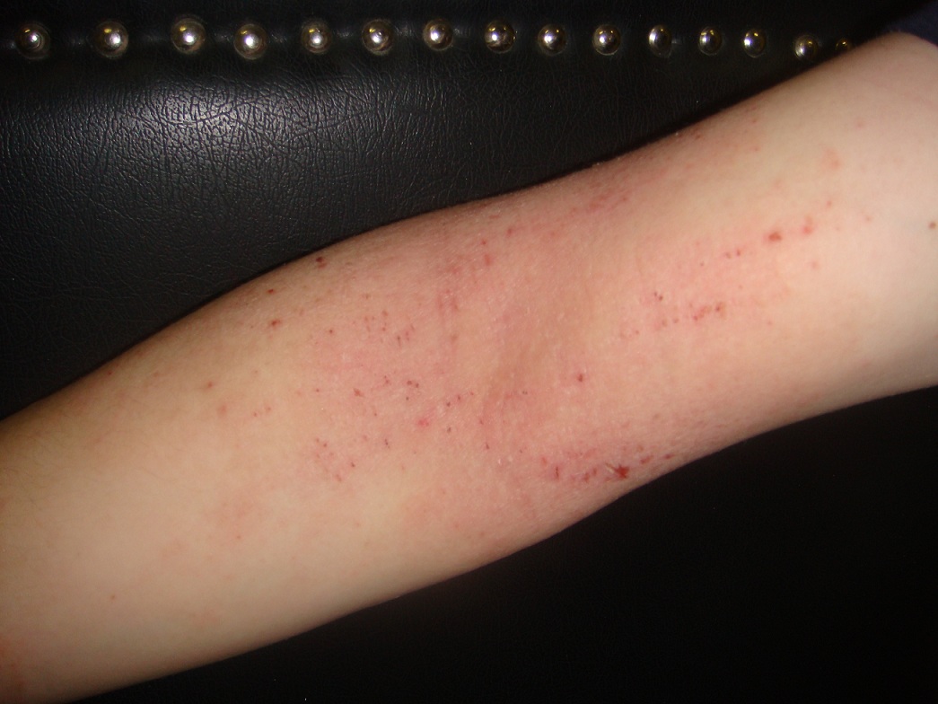 atópiás dermatitisz kezelése