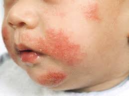 allergiás ekcéma kezelése